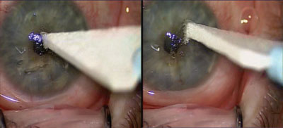 Figure 3.  Attempts at removing the superficial layers of the cornea using a Weck-Cel spear are not successful.