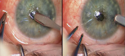 Figure 5. Starting from the central region of the cornea, the epithelium is removed in a circular manner.