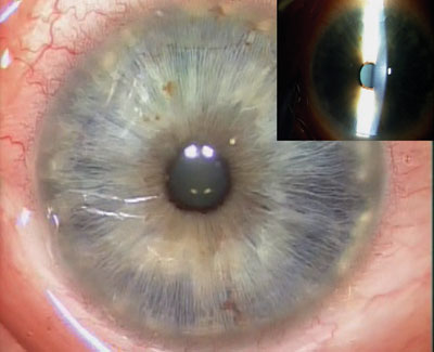 Figure 7. Completed view of superficial keratectomy. The cornea is devoid of all opacities from the map-dot-fingerprint corneal dystrophy.