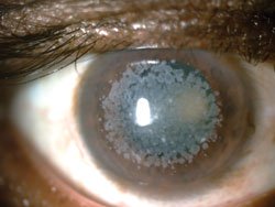 Figure 4: Corneal dystrophy.