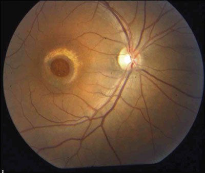 Figure 1: Full-thickness neural retinal hole with smooth edges. There is RPE atrophy within the hole and an RPE atrophic halo surrounding the hole.