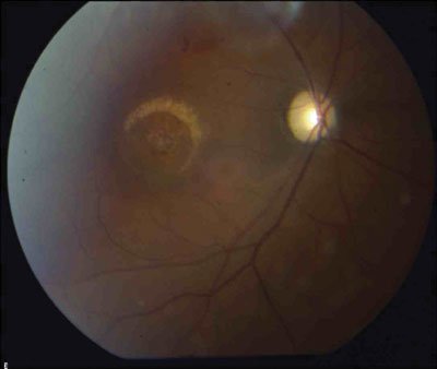 Figure 2: At 2 months postop, the macular hole is closed.