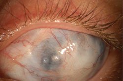 Preoperative Peters anomaly with significant dysgenesis.