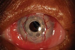 Three-year postoperative appearance. Semi-scleral bandage lens in place over prosthesis. Patient wears goggles to maintain ocular surface.