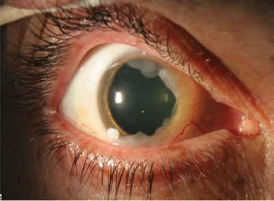 Patient with annular ocular surface squamous neoplasia, biopsy proven.