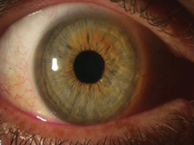 Resolved ocular surface squamous neoplasia after five subconjunctival injections.