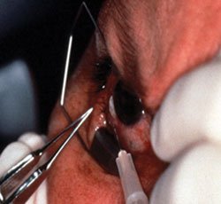 Patient with ocular surface squamous neoplasia receiving subconjunctival injection of interferon alpha-2b.