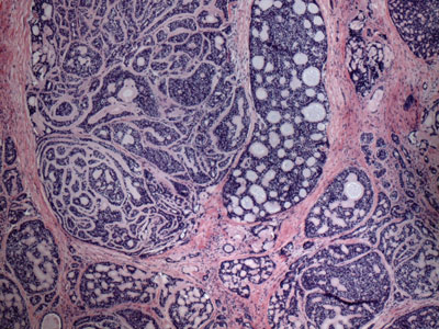 Figure 3. Biopsy of the lacrimal gland lesion showed a cribriform and tubular growth pattern of tumor cells with pools of mucin.