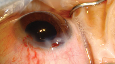 Figure 1.  A very tight phaco incision and excessive ultrasonic energy can result in a phaco wound burn, causing a fish-mouth appearance to the corneal incision.