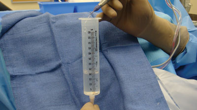 Figure 2.  Measure the actual amount of fluidic inflow at a specific bottle height by filling an empty syringe using the phaco handpiece for 1 minute.