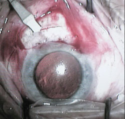 Figure 1. Guarded depth incision. 