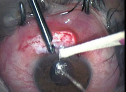 Figure 3.  Jacobs punch with segment of tissue.