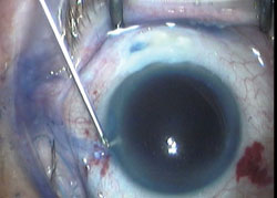 Figure 6. Previous modified trabeculectomy showing functioning bleb after introducing Vision Blue during cataract surgery.