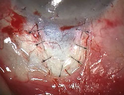 Figure 10. Watertight closure of the superficial flap with seven interrupted 10-0 nylon sutures. 