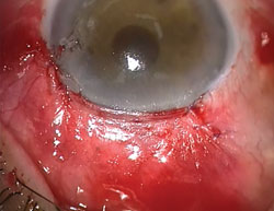 Figure 11. Closed conjunctival flap. Completed view of the procedure.