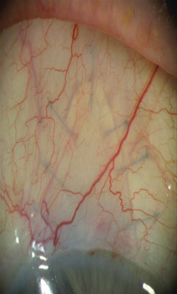 Figure 12. No bleb formation 2 months after canaloplasty.