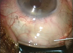 Figure 1. Subconjunctival injection of anesthetics.