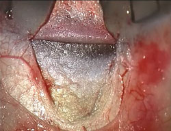 Figure 2. The superficial flap is dissected with the margins extending about 1 mm into clear cornea