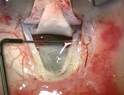 Figure 5. Dilation of the ostiae with a microcannula and OVD facilitates the insertion of the microcatheter.