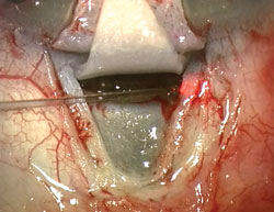 Figure 6. The shaft of the microcatheter must be inserted in line and in plane with the ostia. Note the red beacon tip.