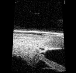 Figure 9. Ultrasound biomicroscopy (80 MHz) of the chamber angle. 