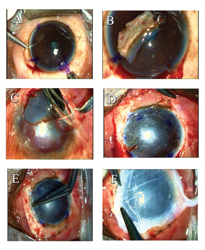 Figure 1. Conjunctival limbal autograft 