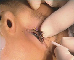 Figure 1. Carefully dilate the upper lacrimal punctum.