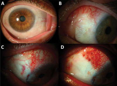 Figure 2. Grading of postoperative host conjunctival inflammation.