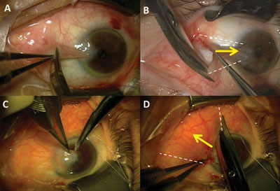 Figure 3. Different approach for primary and recurrent pterygia. 