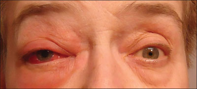 Figure 1. Significant right-sided periorbital edema and erythema. Ptosis and anisocoria are seen as well. 