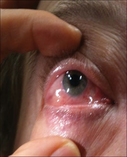 Figure 2. Right eye chemosis with inferior dilated corkscrew vessels.