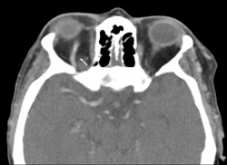 Figure 3. A dilated right superior ophthalmic vein (left, arrow) are present on scans.