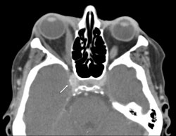 Figure 3. Enlarged cavernous sinus (right) are present on scans.