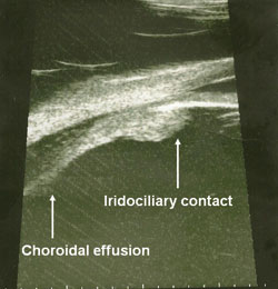 Figure 4.  Ciliary-choroidal effusion with anterior rotation of the ciliary body and shallowing of the anterior chamber vessels.