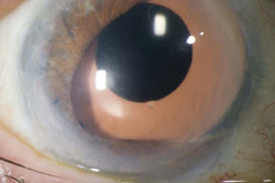 Two and a half years after DSEK, the cornea remains clear and corrected distance visual acuity is 20/40.