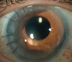 Patient with partial aniridia and corneal edema following implantation of Ophtec 311 iris reconstruction lens.