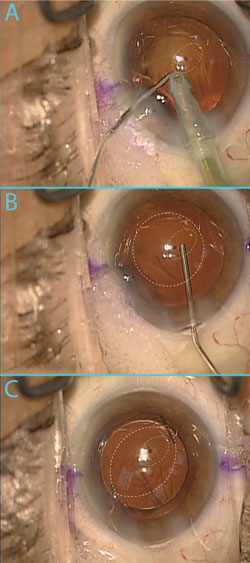 Once a posterior capsule break (outlined in green) is detected, a dispersive viscoelastic is injected through the defect to prevent vitreous prolapse