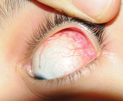 Figure 1. External photographs showing superior-lateral scleral injection and enlarged lacrimal gland in the left eye. 