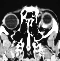 Figure 2.  Axial CT image demonstrating a focal, enhancing, anterior intraconal mass with irregular unencapsulated borders and lateral rectus muscle enlargement in the left eye.