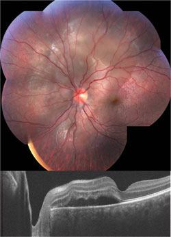 Figure 3.  Fundus photograph (top) and Carl Zeiss Meditec Cirrus HD-OCT scan (below) of the left eye showing exudative retinal detachment encroaching on the macula