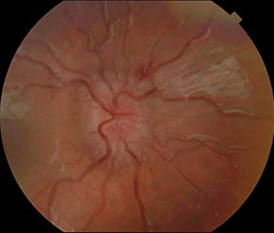 Figure 1a. Optic disc photo of the right eye showing disc edema, venous engorgement and peripapillary splinter hemorrhage superonasally.