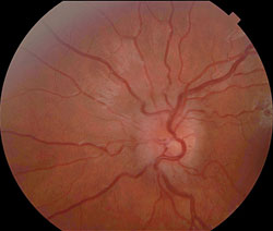 Figure 1b. Optic disc photo of the left eye showing disc edema and venous engorgement.