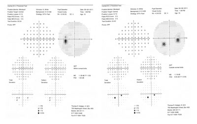 Figure 2.  HVF 30-2 demonstrating mild enlargement of the blind spot bilaterally.