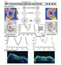 Figure 3. OCT retinal nerve fiber layer demonstrating optic nerve head swelling bilaterally.