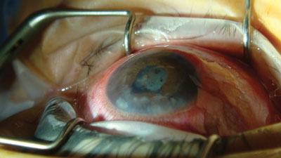 An eye with a less than 1-mm deep anterior chamber and a history of angle closure with white cataract formation.