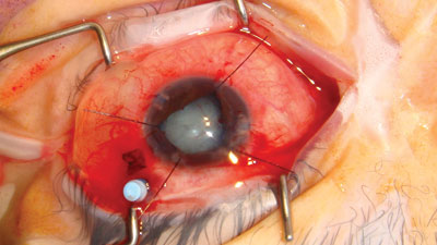 With a deepened anterior chamber the capsule was stained with trypan blue and a capsulorrhexis was created. Iris hooks were needed to enlarge the pupil for cataract surgery.