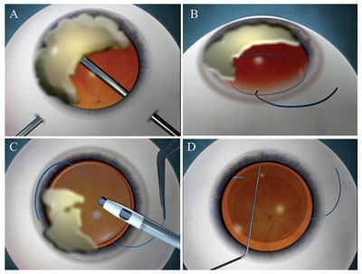 Figure 1. The nuclear fragment is brought above the iris (a). The IOL is injected so as to insert the leading haptic above the iris and the optic covering the pupillary area (b). The nucleus is emulsified using the phaco probe while using the IOL as a scaffold to prevent the lens pieces from falling into the vitreous cavity (c). The IOL is dialed into the sulcus (d). 