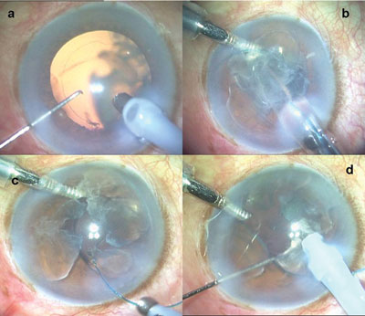 Figure 2. Posterior capsular rent with retained nucleus (a). The nucleus is brought out of the bag into the anterior chamber. The IOL is then injected into the anterior chamber with the leading haptic over the iris and under the nuclear fragments (b). The trailing haptic is left outside the wound (c). The nucleus is emulsified over the surface of the IOL using the IOL as a scaffold to prevent nuclear fragments from falling down into the vitreous cavity (d).