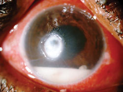 Figure 2. Corneal ulcer.