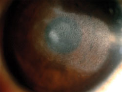 Figure 3. Corneal opacity.